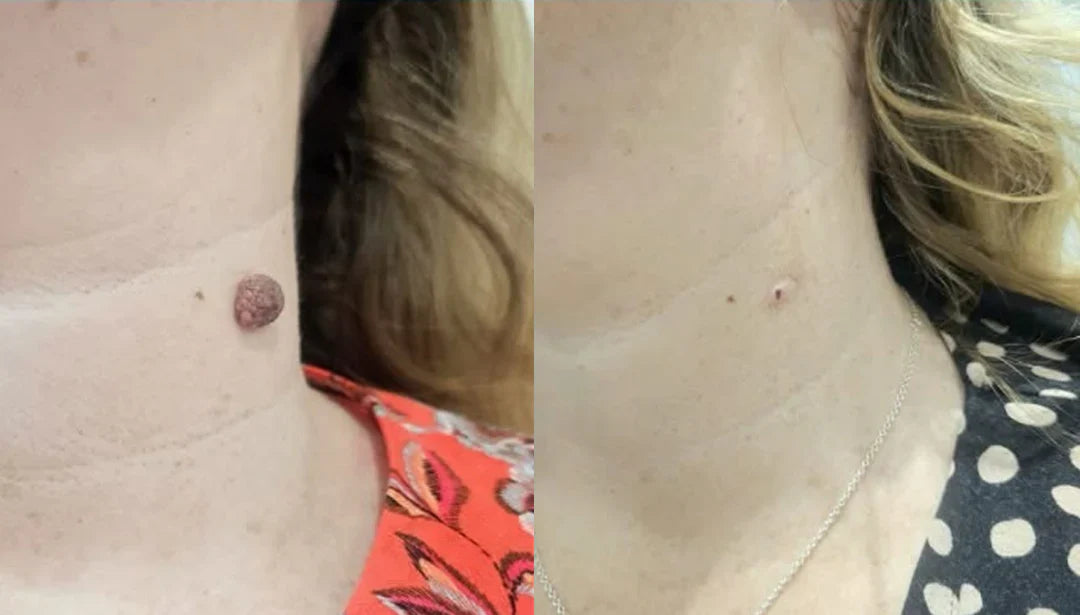 The KeraErase Dual-Action Cream - Non-Acidic Renewal for Warts, Tags, and Keratin Buildup + 50% OFF