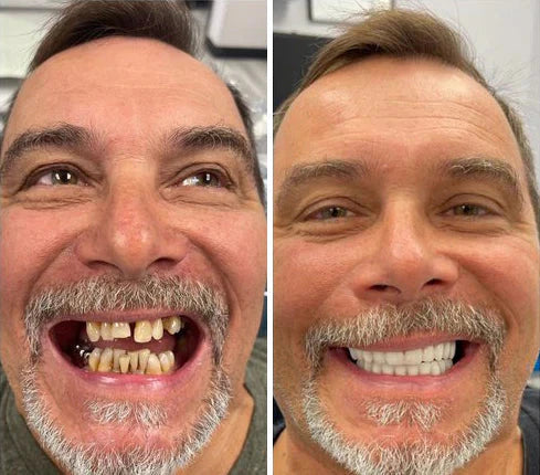 ComfortFit Reline Dentures - A Secure Smile, No Dentist Visit + 50% OFF
