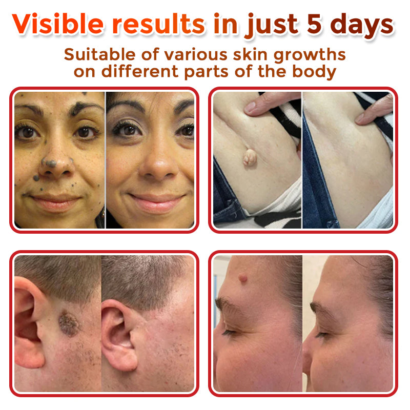The DermaPoint Patch - Skin Tags Gone in Days, Guaranteed - 50% OFF
