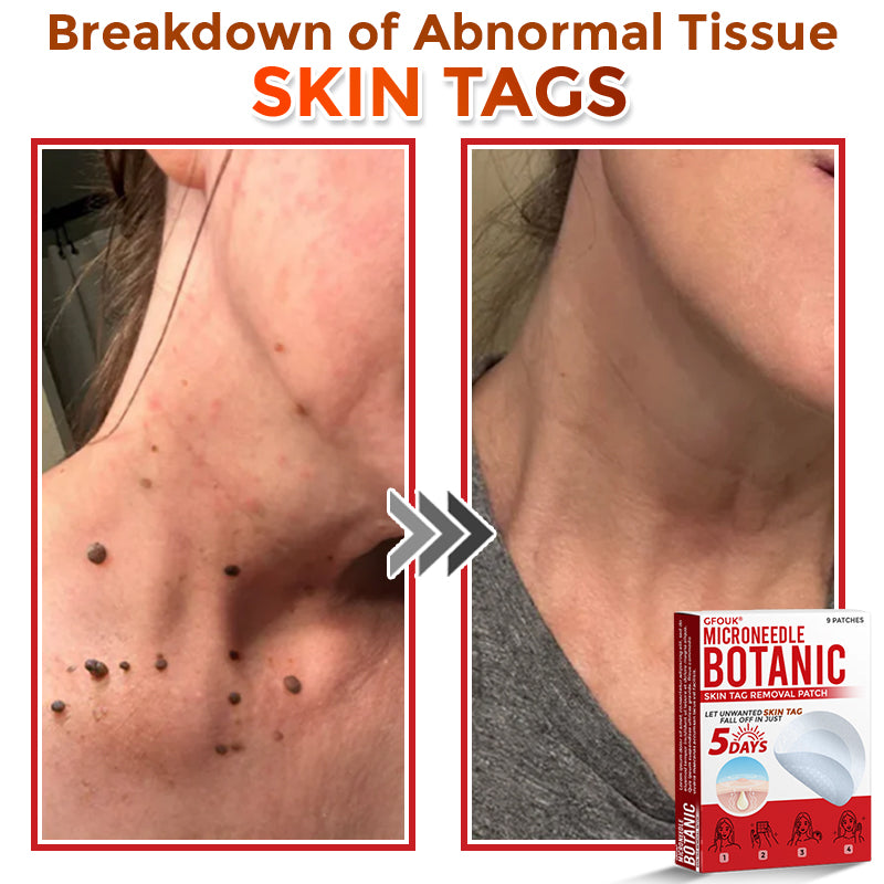 The DermaPoint Patch - Skin Tags Gone in Days, Guaranteed - 50% OFF