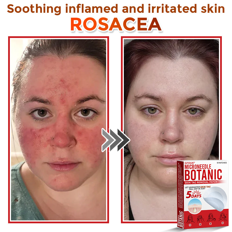 The DermaPoint Patch - Skin Tags Gone in Days, Guaranteed - 50% OFF