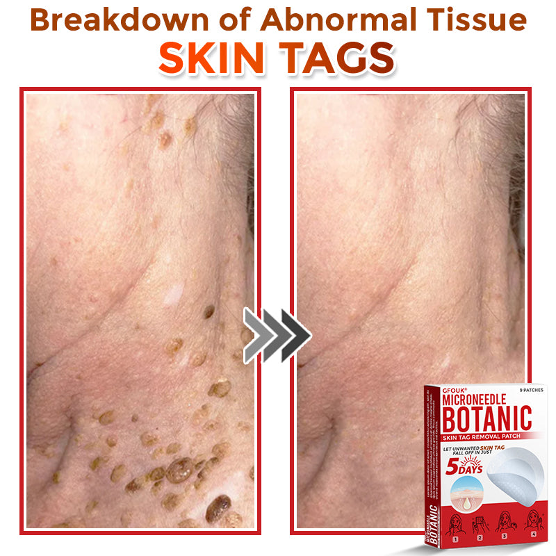 The DermaPoint Patch - Skin Tags Gone in Days, Guaranteed - 50% OFF