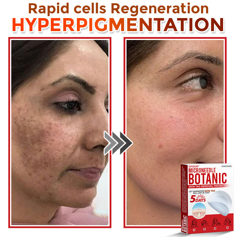 The DermaPoint Patch - Skin Tags Gone in Days, Guaranteed - 50% OFF