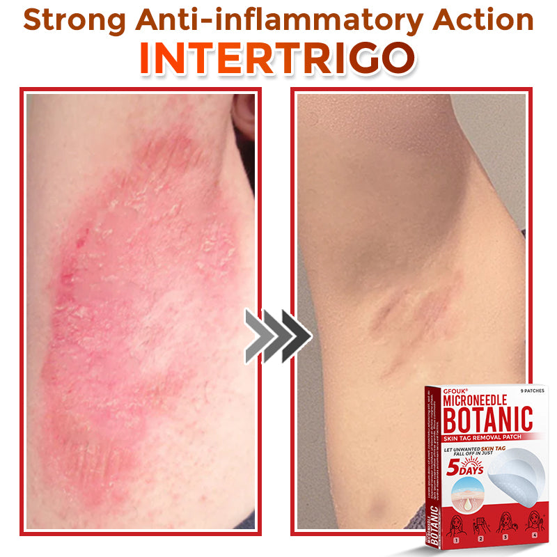 The DermaPoint Patch - Skin Tags Gone in Days, Guaranteed - 50% OFF