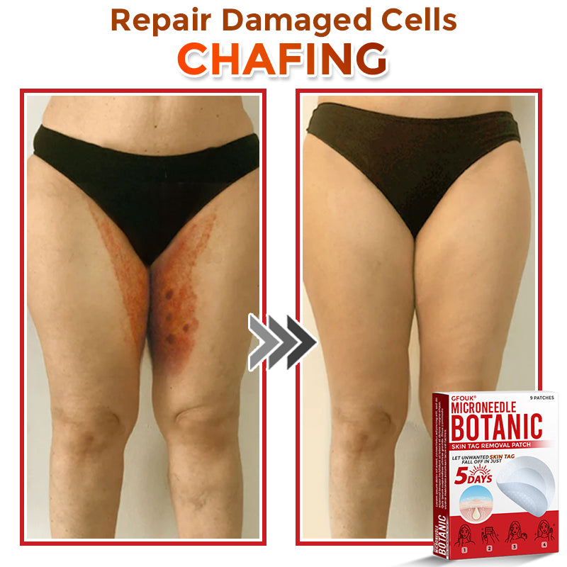 The DermaPoint Patch - Skin Tags Gone in Days, Guaranteed - 50% OFF