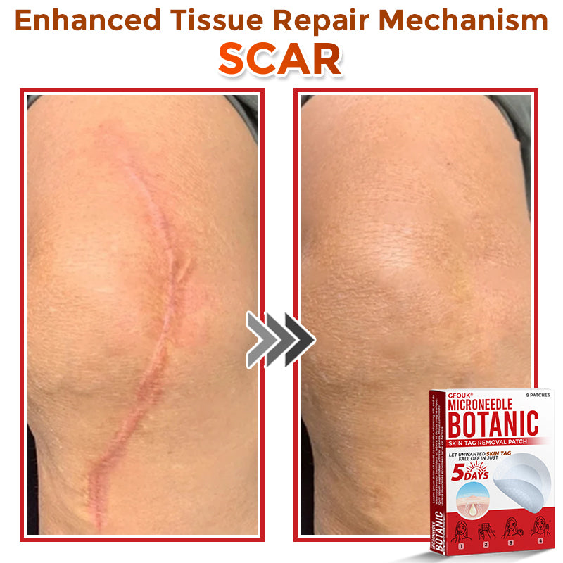The DermaPoint Patch - Skin Tags Gone in Days, Guaranteed - 50% OFF