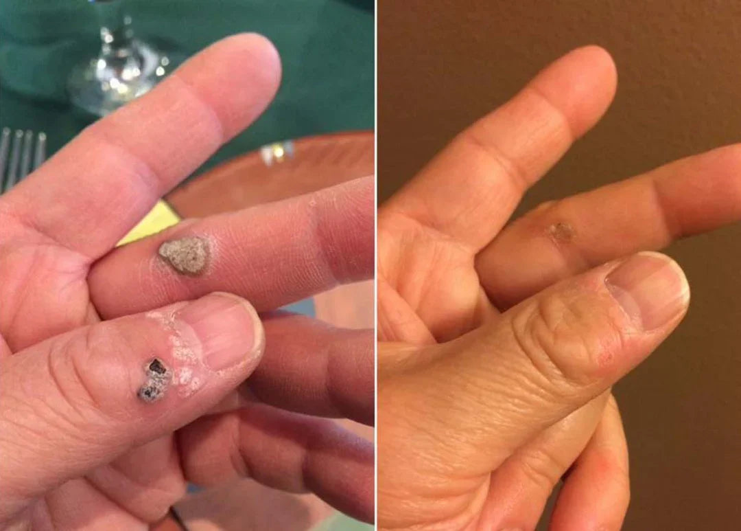 The KeraErase Dual-Action Cream - Non-Acidic Renewal for Warts, Tags, and Keratin Buildup + 50% OFF