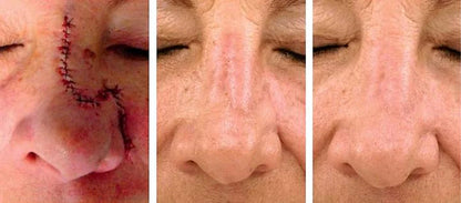 ScarRefine – Erase Scars & Restore Texture + 50% OFF TODAY