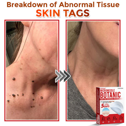 The DermaPoint Patch - Skin Tags Gone in Days, Guaranteed - 50% OFF