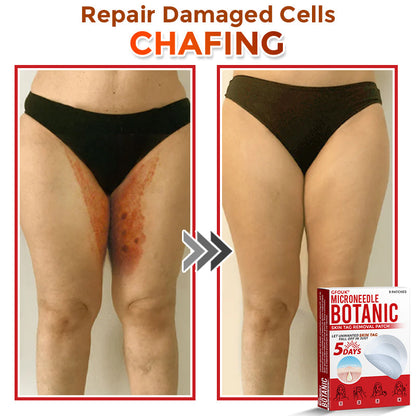 The DermaPoint Patch - Skin Tags Gone in Days, Guaranteed - 50% OFF